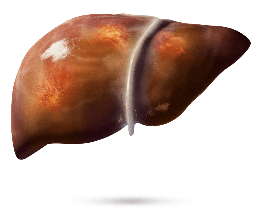 Ilustración médica de un hígado con fibrosis visible.