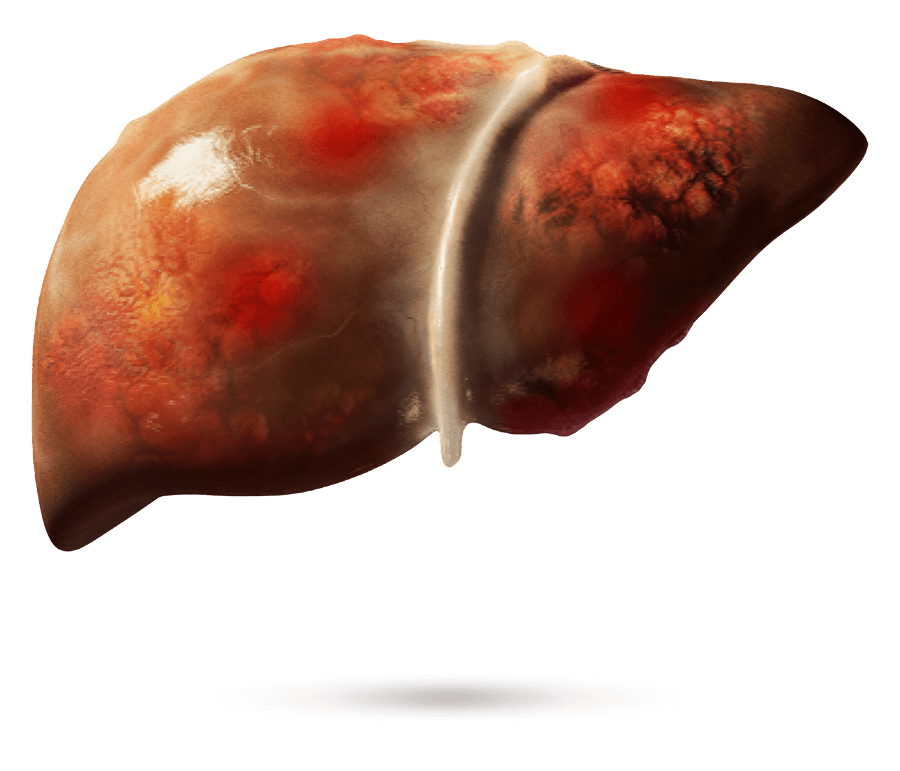 Ilustración médica de un hígado con fibrosis visible.
