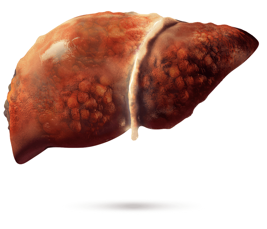 Ilustración médica de un hígado con fibrosis visible.